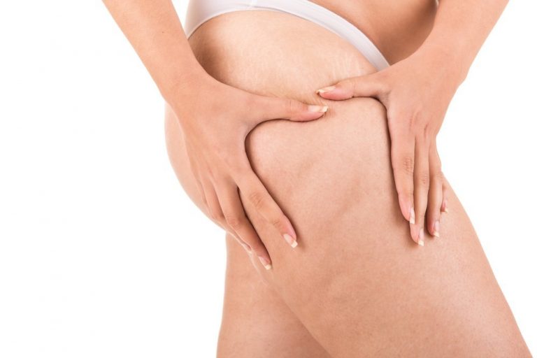 Jak usunąć cellulit do lata? Zapisz się na serię zabiegów endermologii i pożegnaj skórkę pomarańczową!