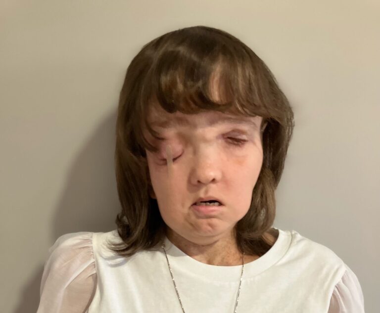 Dla kogo 1,5% podatku? Joanna Gnosowska po przeszczepie twarzy wciąż potrzebuje pomocy