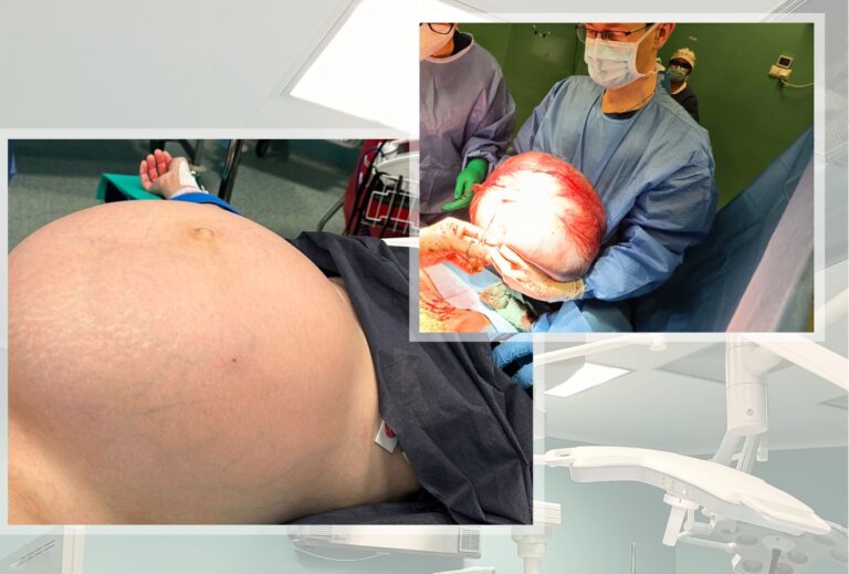 Kolejny gigantyczny guz jajnika zoperowany w świdnickim szpitalu