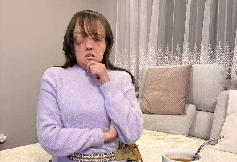 Komu przekazać 1,5% podatku? Wesprzyj Joannę Gnosowską po przeszczepie twarzy